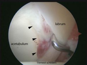 labral detachment hip scope