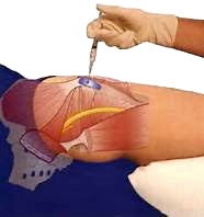 trochanteric-bursa-injection